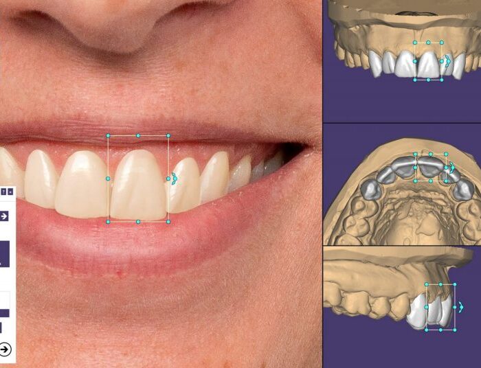 Exocad DentalCAD patch 2.3 Matera crack 2020