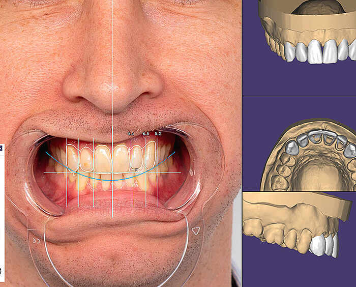 Library of teeth (Exocad)