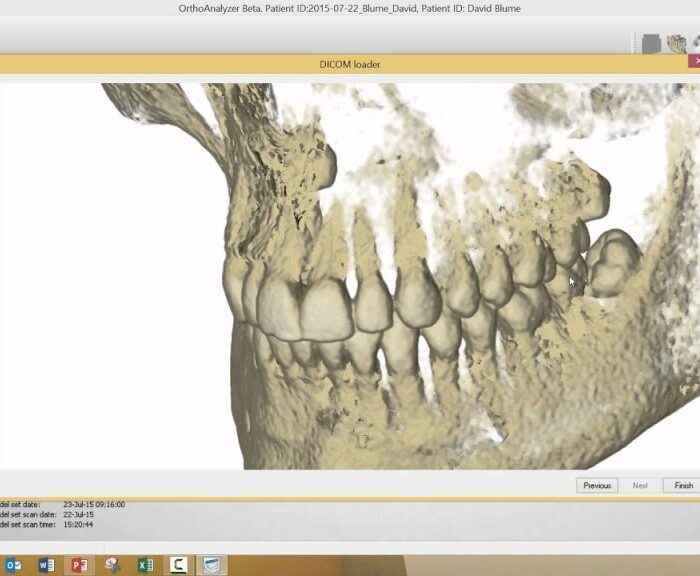 3Shape Ortho System crack